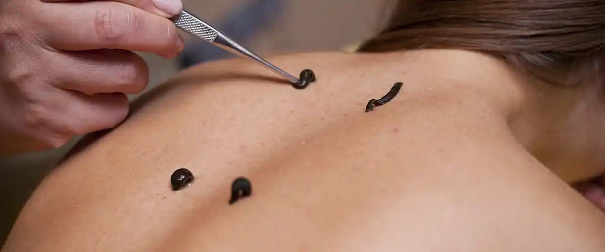 Blutegeltherapie & Bioresonanz